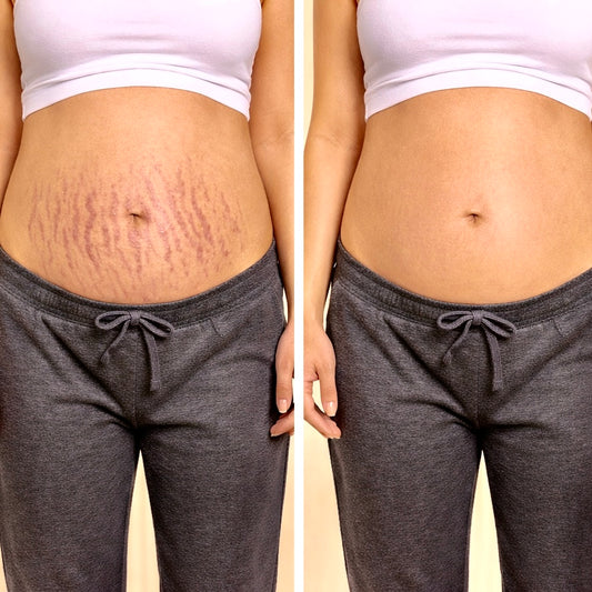 Pregnancy Stretch Marks Removal